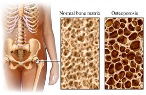 osteoporosis_porosidad